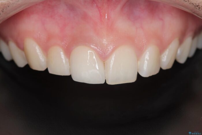 欠けた前歯、根管治療からやり直す アフター