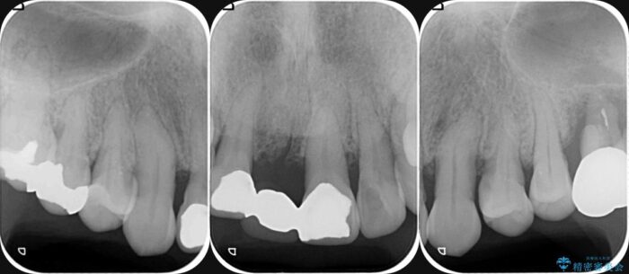 中等度歯周病の治療後にセラミックで美しい前歯に 治療前画像