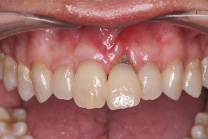 歯ぐきのボリュームを回復しブリッジで自然で美しい歯に 治療前画像