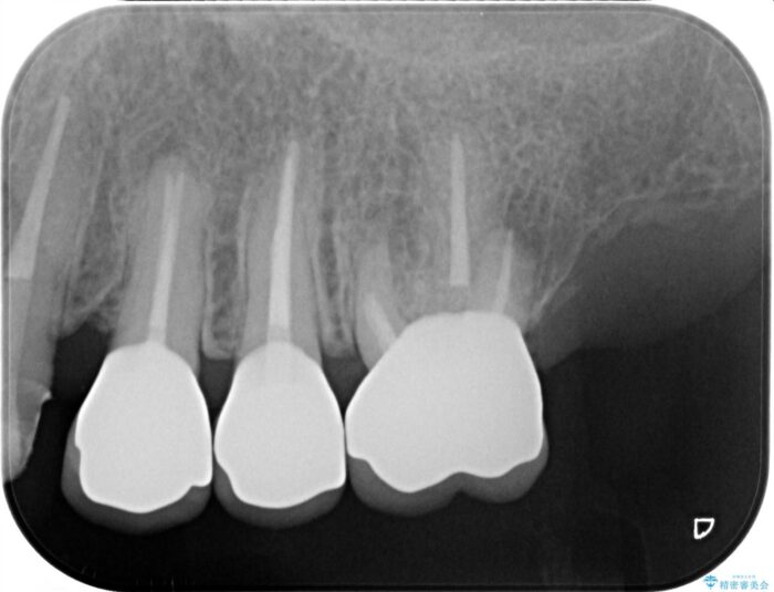 清掃しやすいクラウンへ 治療後画像