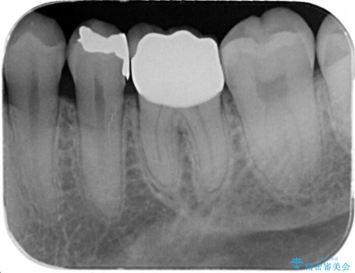 適合の悪い銀歯をセラミックへ 治療後画像