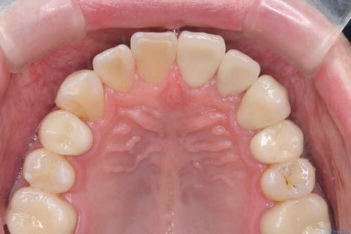 前歯の歯間の虫歯、セラミックで美しく 治療後画像