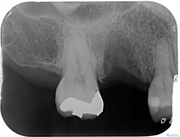 虫歯で失った奥歯、インプラント治療で咬合機能の回復 治療途中画像