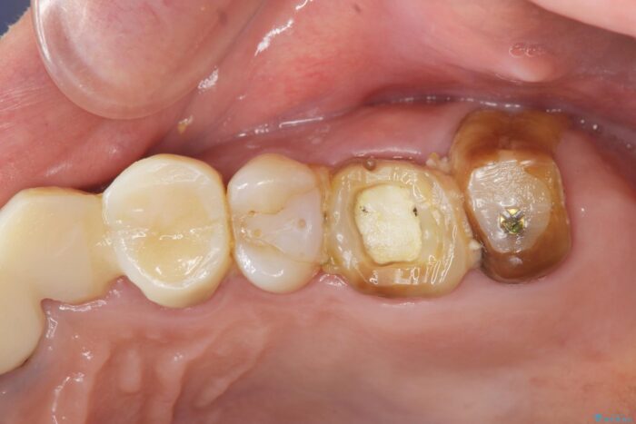 清掃しやすいクラウンへ 治療前画像