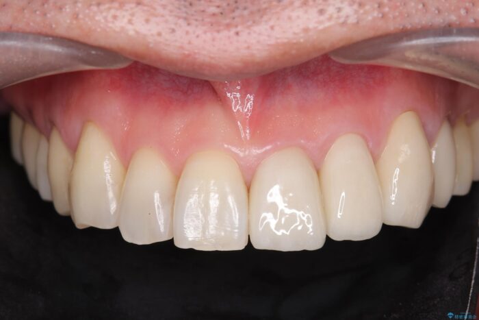 前歯の歯間の虫歯、セラミックで美しく 治療後画像