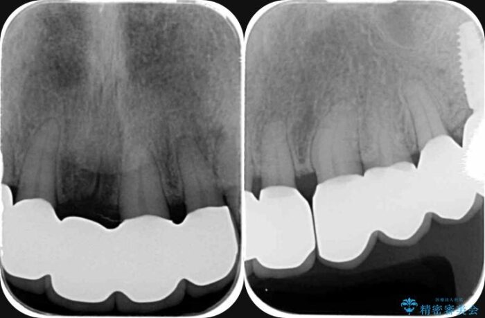 中等度歯周病の治療後にセラミックで美しい前歯に 治療後画像