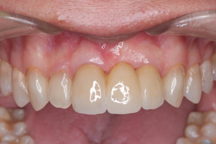 歯ぐきのボリュームを回復しブリッジで自然で美しい歯に 治療後画像