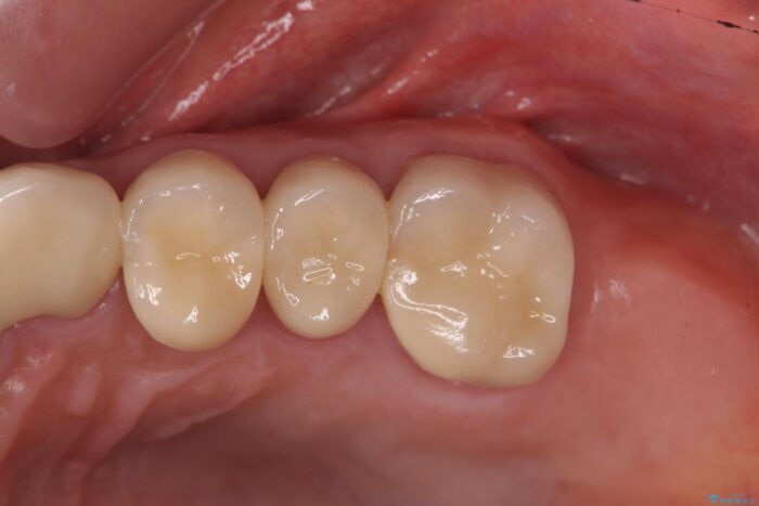 清掃しやすいクラウンへ 治療後画像