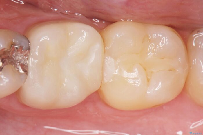 適合の悪い銀歯をセラミックへ 治療後画像