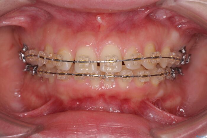 ワイヤー矯正で深い噛み合わせ、すきっ歯の改善 治療途中画像