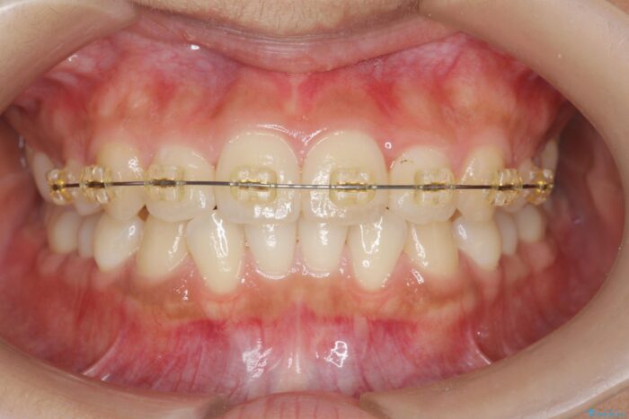 部分ワイヤーとマウスピース矯正の併用で前歯のねじれ、すれ違いを改善 治療途中画像