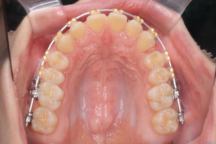 ワイヤー矯正で深い噛み合わせ、すきっ歯の改善 治療途中画像
