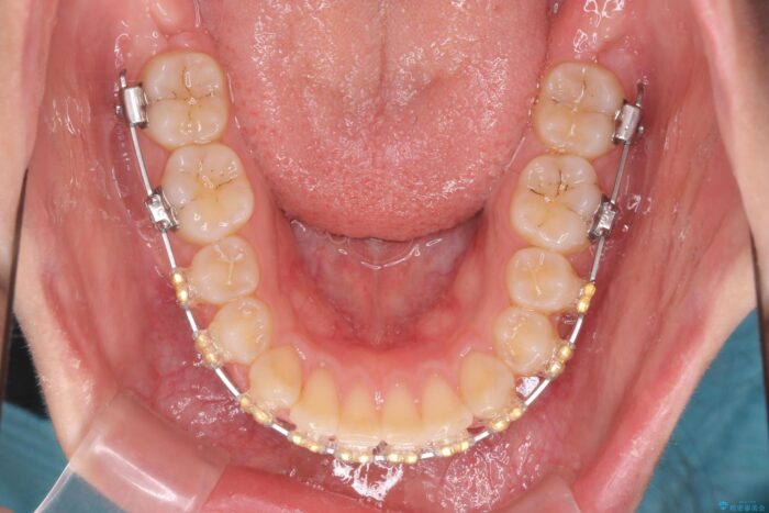 ワイヤー矯正で深い噛み合わせ、すきっ歯の改善 治療途中画像