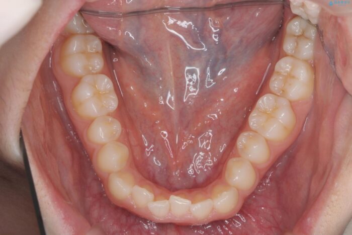 部分ワイヤーとマウスピース矯正で前歯のねじれ、がたつきをしっかり改善 治療途中画像