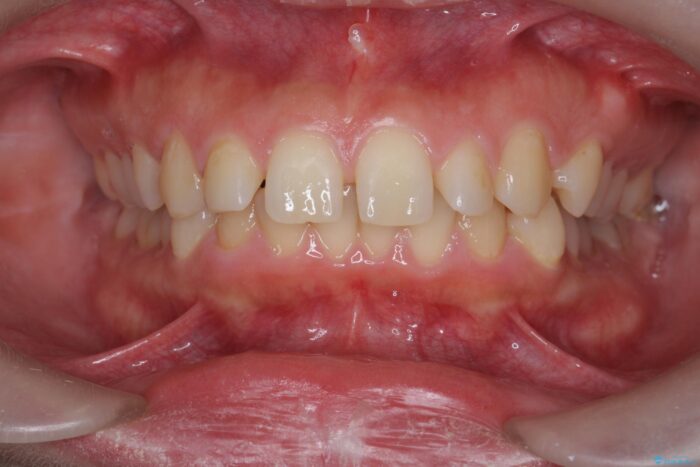 ワイヤー矯正で深い噛み合わせ、すきっ歯の改善 ビフォー