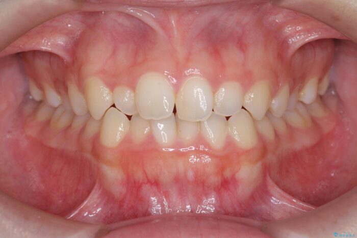 部分ワイヤーとマウスピース矯正で前歯のねじれ、がたつきをしっかり改善 ビフォー