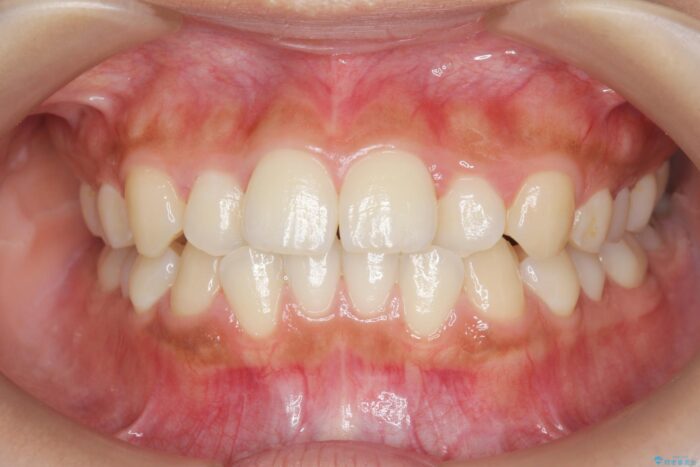 部分ワイヤーとマウスピース矯正の併用で前歯のねじれ、すれ違いを改善 ビフォー