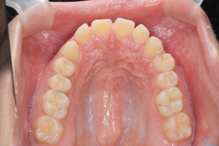 ワイヤー矯正で深い噛み合わせ、すきっ歯の改善 治療前画像