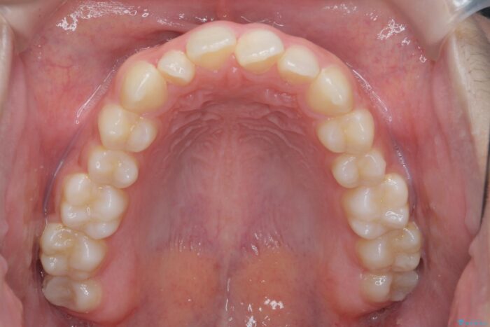 部分ワイヤーとマウスピース矯正で前歯のねじれ、がたつきをしっかり改善 治療前画像