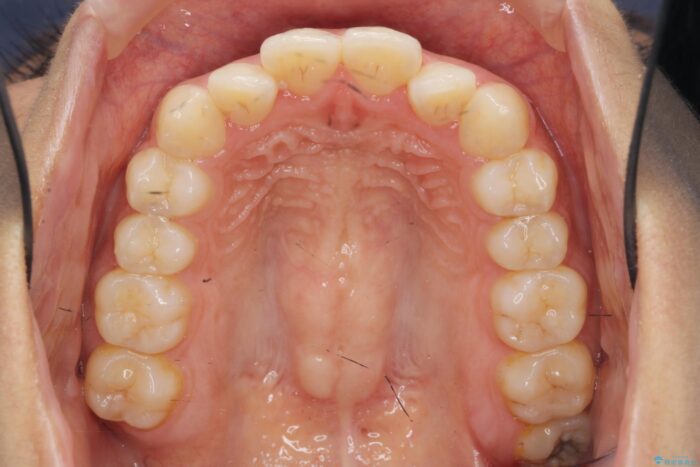 部分ワイヤーとマウスピース矯正の併用で前歯のねじれ、すれ違いを改善 治療前画像