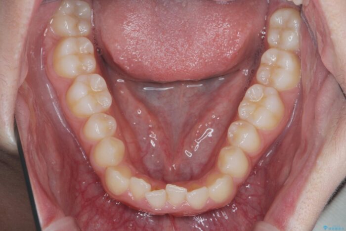 部分ワイヤーとマウスピース矯正で前歯のねじれ、がたつきをしっかり改善 治療前画像