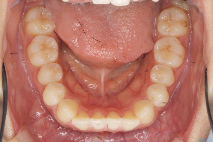 部分ワイヤーとマウスピース矯正の併用で前歯のねじれ、すれ違いを改善 治療前画像