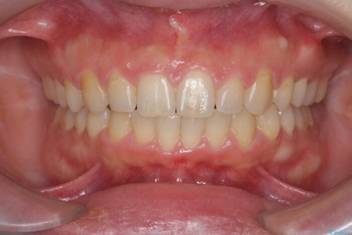 ワイヤー矯正で深い噛み合わせ、すきっ歯の改善 治療後画像