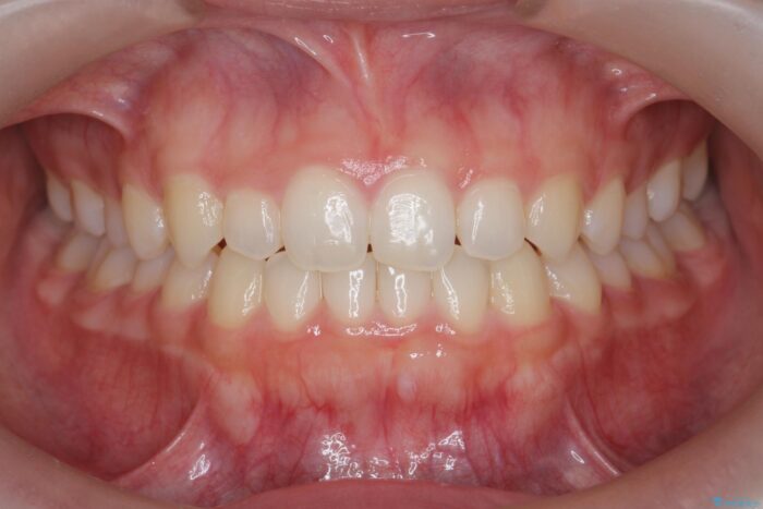 部分ワイヤーとマウスピース矯正で前歯のねじれ、がたつきをしっかり改善 治療後画像