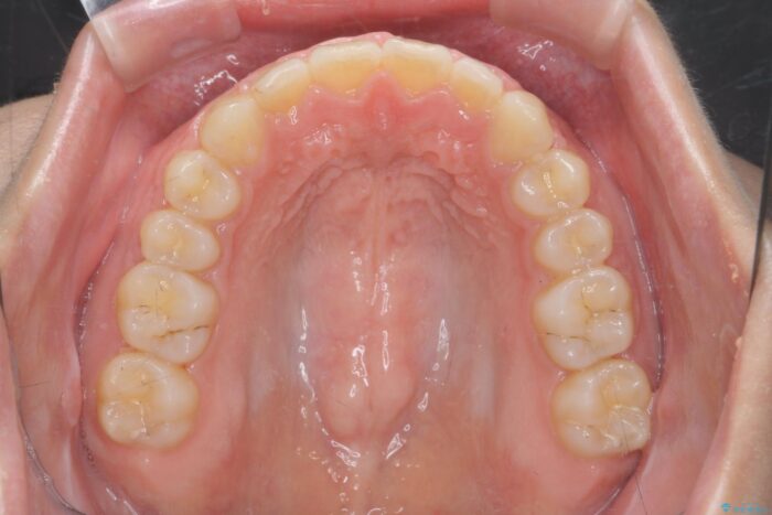 ワイヤー矯正で深い噛み合わせ、すきっ歯の改善 治療後画像