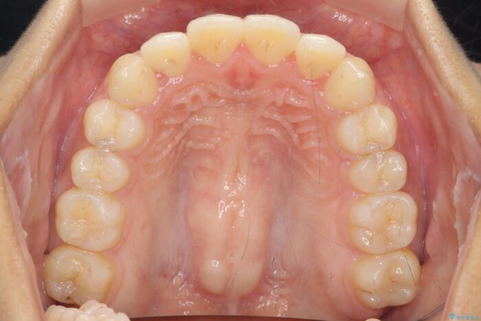 部分ワイヤーとマウスピース矯正の併用で前歯のねじれ、すれ違いを改善 治療後画像
