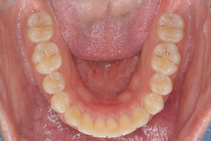 ワイヤー矯正で深い噛み合わせ、すきっ歯の改善 治療後画像