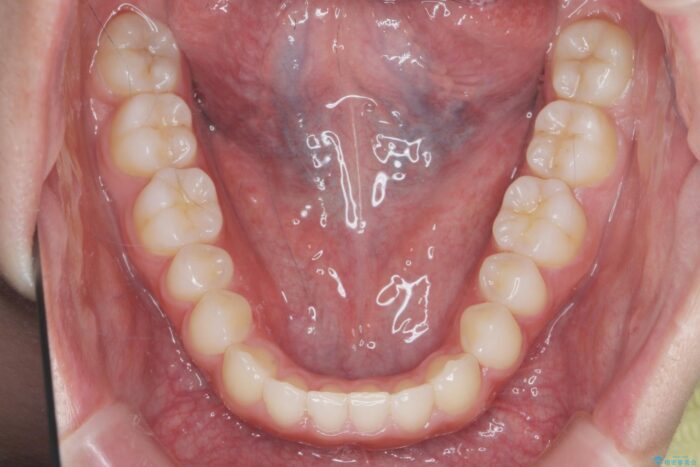 部分ワイヤーとマウスピース矯正で前歯のねじれ、がたつきをしっかり改善 治療後画像