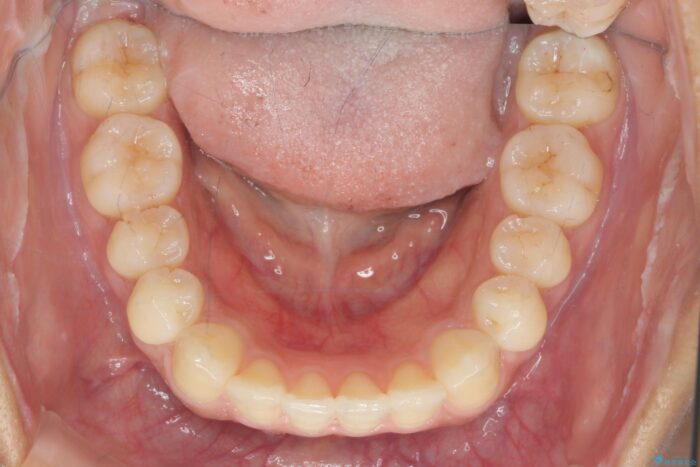 部分ワイヤーとマウスピース矯正の併用で前歯のねじれ、すれ違いを改善 治療後画像