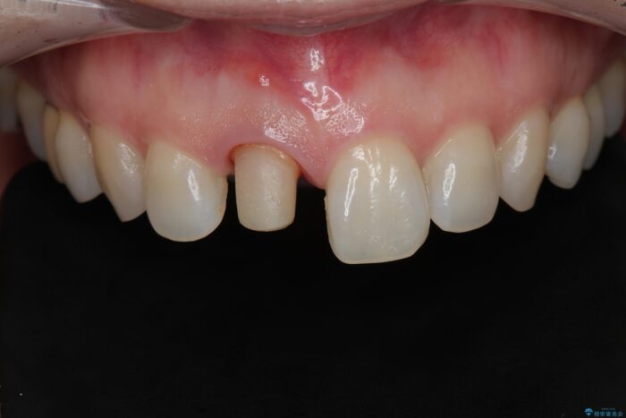 保険治療をした前歯の色が気になる 治療途中画像