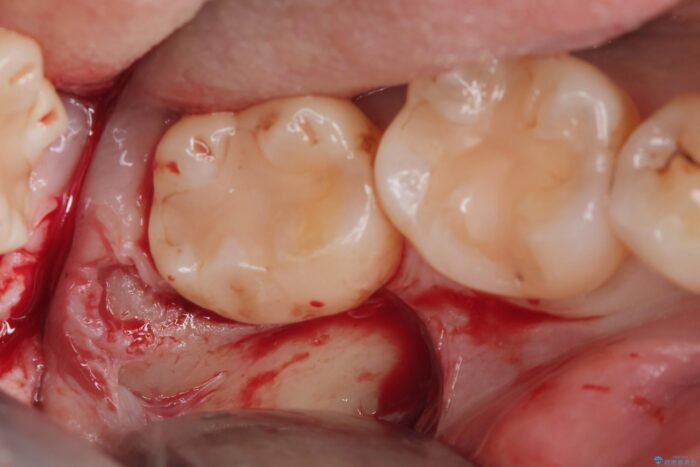 埋伏歯の抜歯 治療途中画像