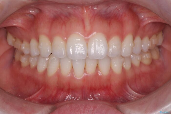前歯のガタつきをインビザラインで治す 治療途中画像