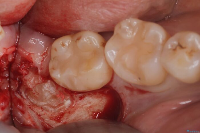 埋伏歯の抜歯 治療途中画像