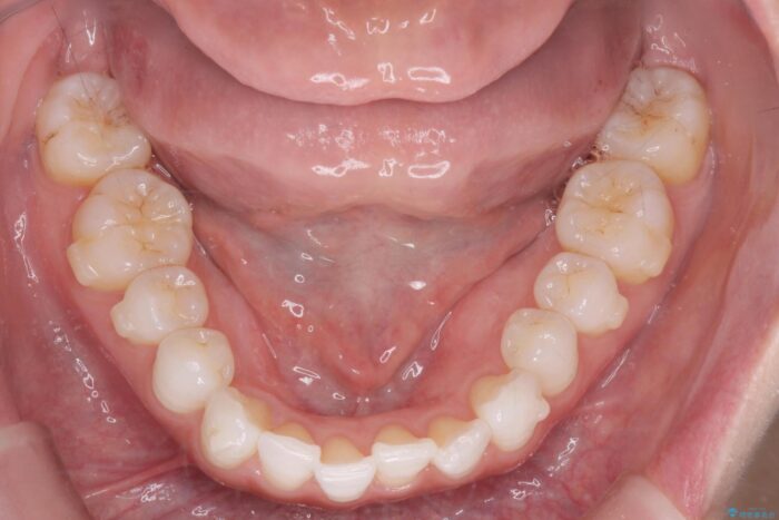 前歯のガタつきをインビザラインで治す 治療途中画像