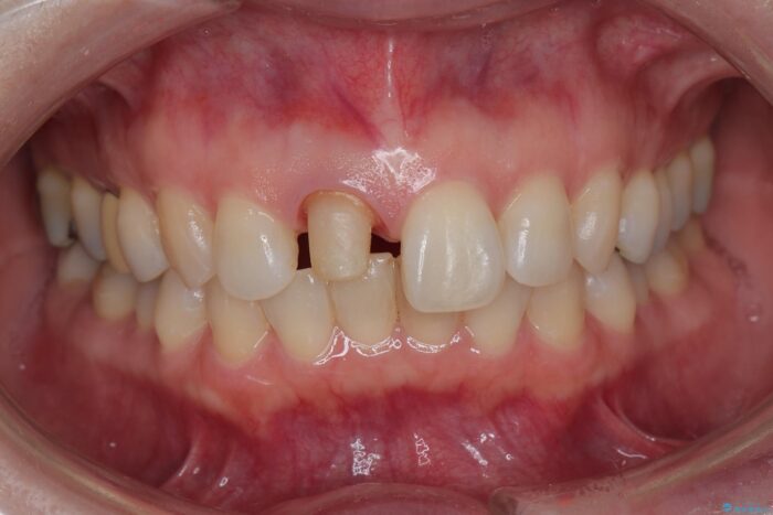 保険治療をした前歯の色が気になる 治療途中画像