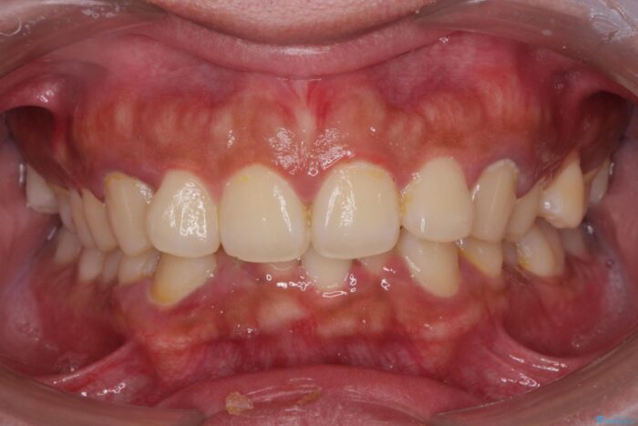 気になるガタつきをインビザラインですっきり ビフォー