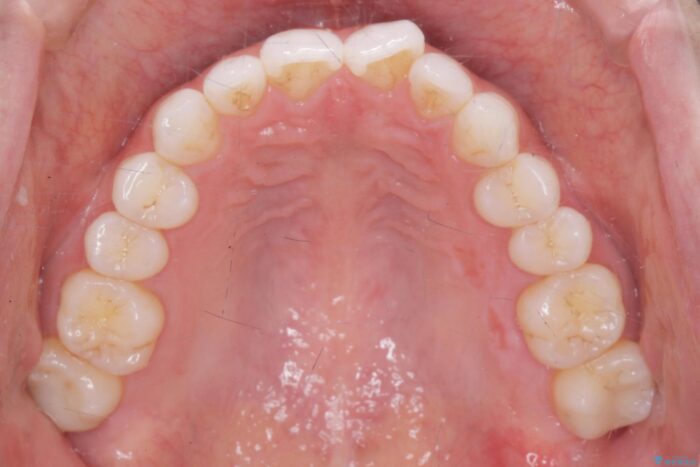 前歯のガタつきをインビザラインで治す 治療前画像