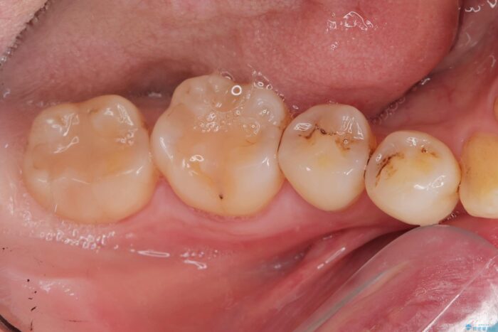 埋伏歯の抜歯 ビフォー