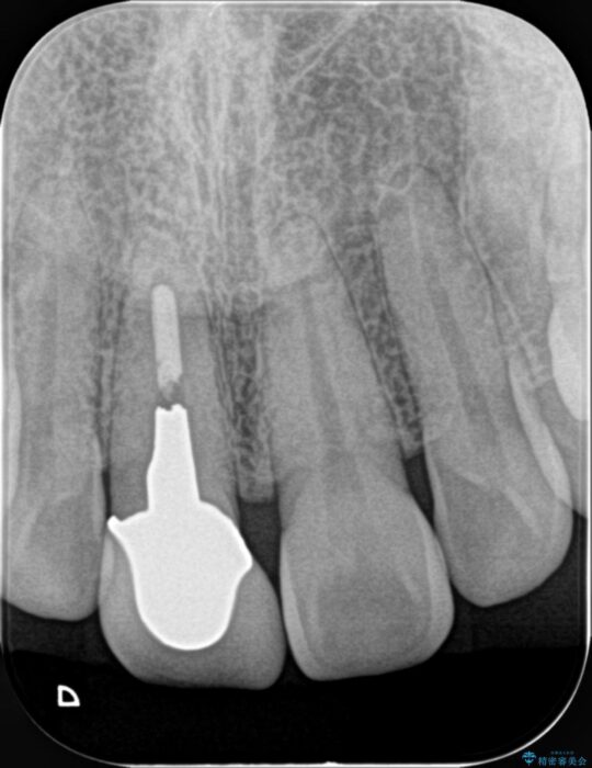 保険治療をした前歯の色が気になる 治療前画像