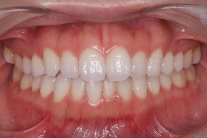 前歯のガタつきをインビザラインで治す ビフォー