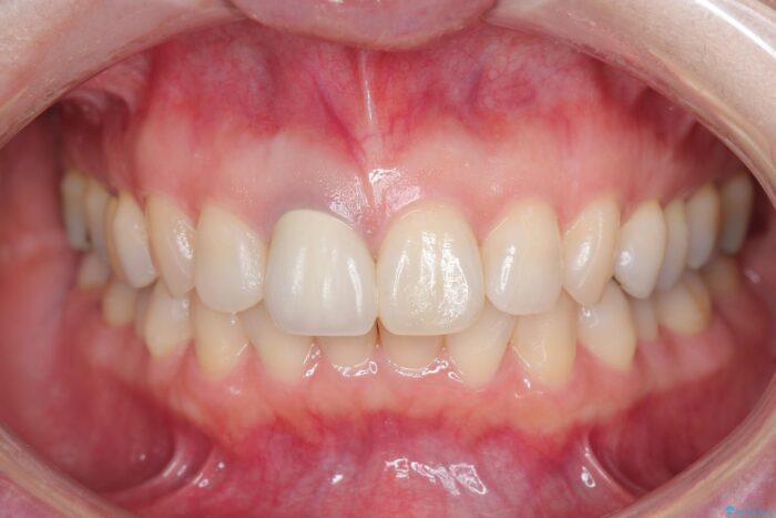 保険治療をした前歯の色が気になる 治療前画像