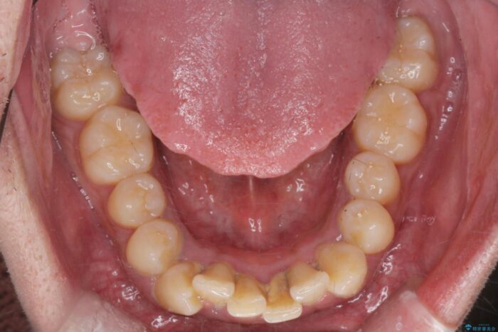 気になるガタつきをインビザラインですっきり 治療前画像