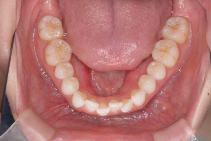 前歯のガタつきをインビザラインで治す 治療前画像