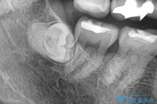 埋伏歯の抜歯 治療前画像