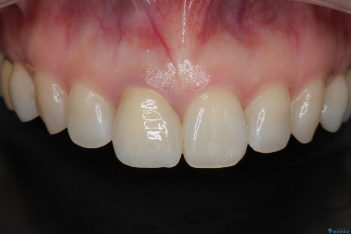 保険治療をした前歯の色が気になる 治療後画像