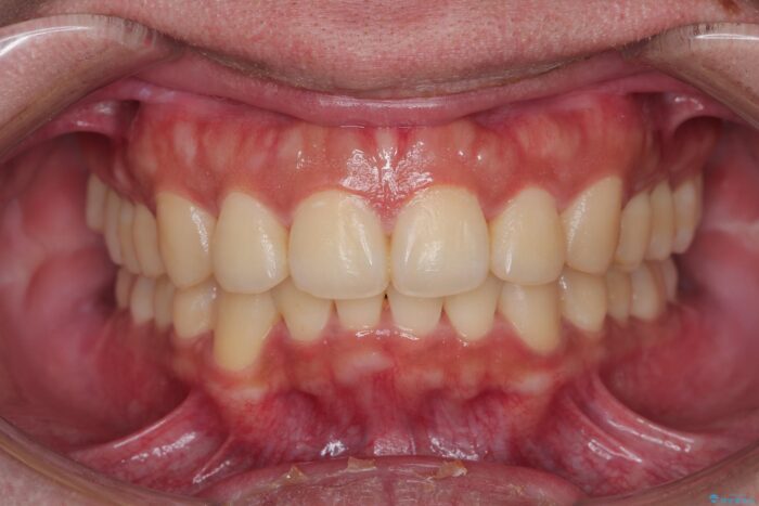 気になるガタつきをインビザラインですっきり 治療後画像